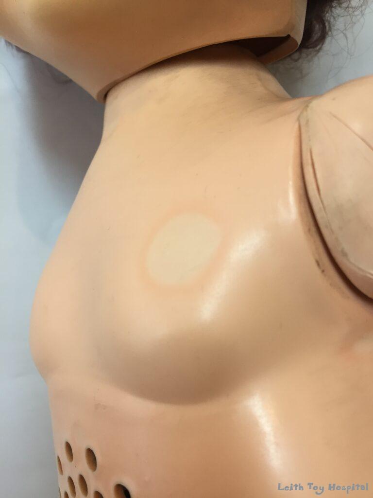 A doll with sad doll disease with a white bulls eye shaped spot on her chest